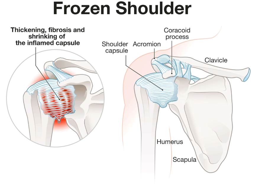 Medical illustration showing the anatomy of frozen shoulder, including inflammation, thickened shoulder capsule, and restricted movement.
